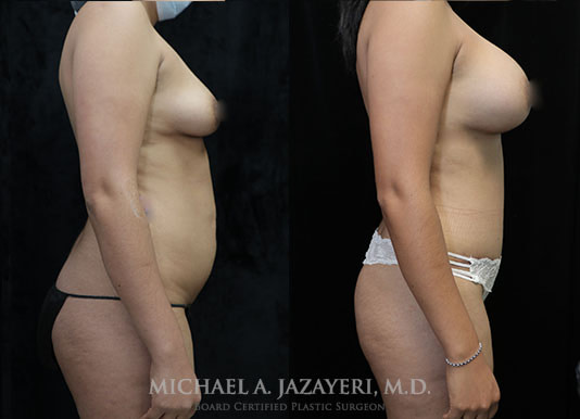 mommy makeover before and after