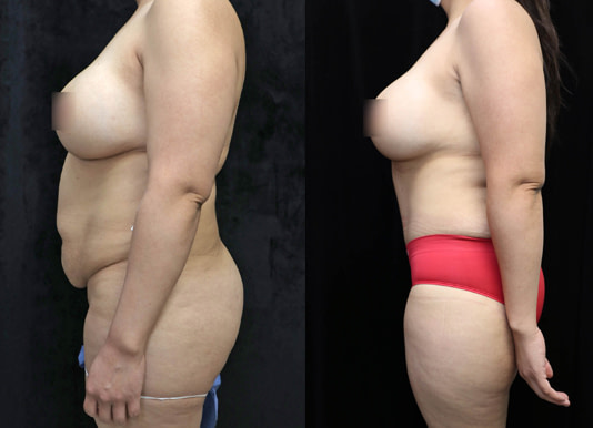 Mommy Makeover Before & After Photos