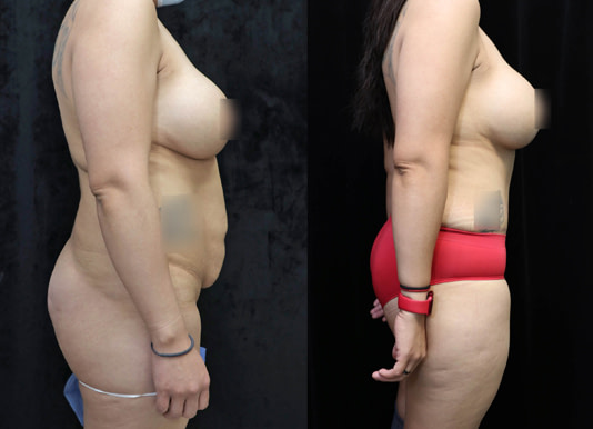 Mommy Makeover Before & After Photos