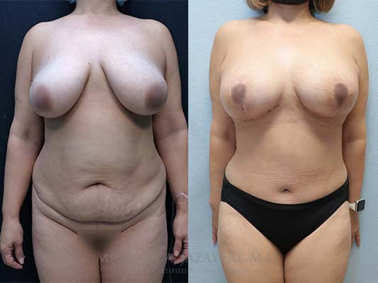 mommy makeover before and after front