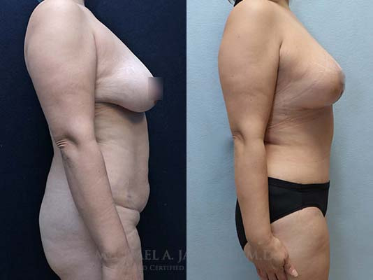 mommy makeover before and after right
