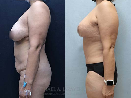 mommy makeover before and after left