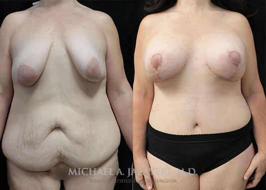 mommy makeover before and after results front