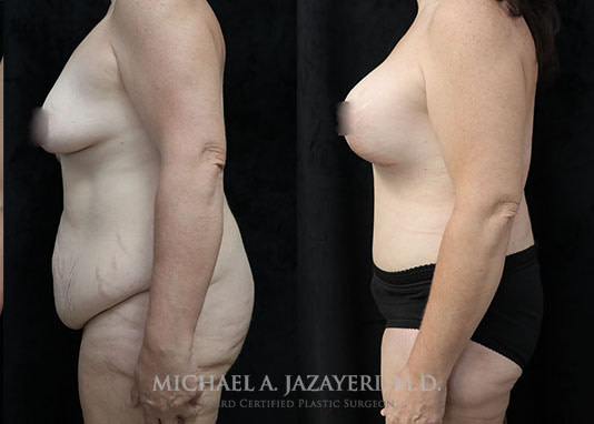 mommy makeover before and after results left