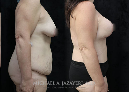mommy makeover before and after results right