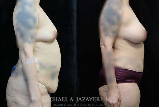 mommy makeover before and after results right