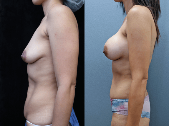 Mommy Makeover Before & After Photos Left Side