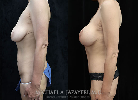 Mommy makeover before and after left