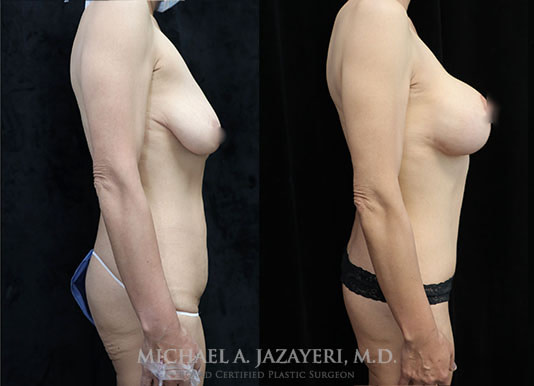 Mommy makeover before and after right