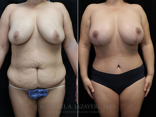 Mommy Makeover before and after