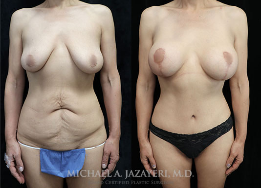 Mommy makeover before and after front