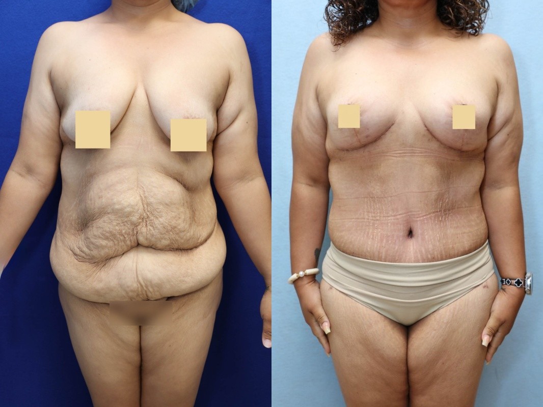 Mommy Makeover Before & After Photos