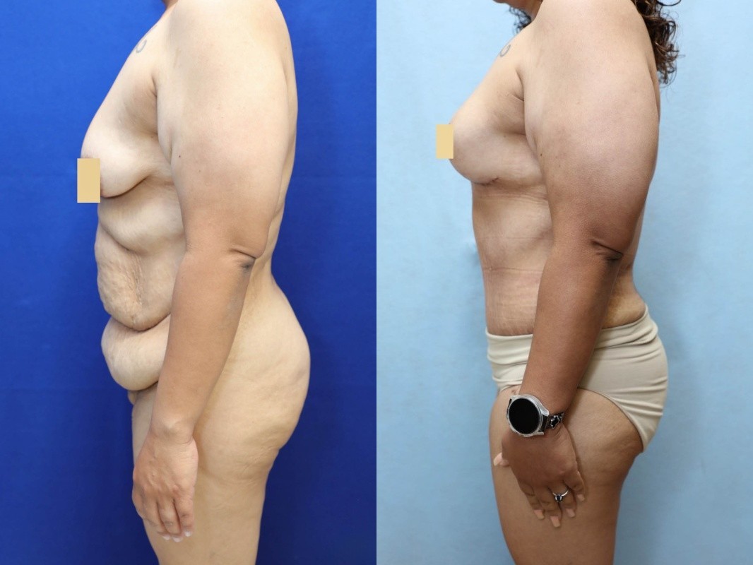 Mommy Makeover Before & After Photos