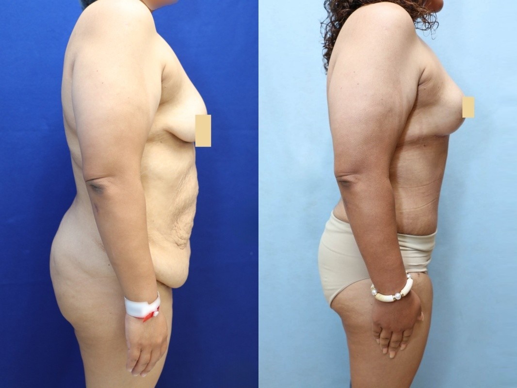 Mommy Makeover Before & After Photos