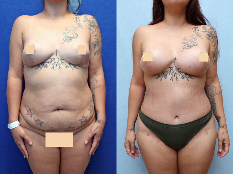 Mommy Makeover before and after, front view