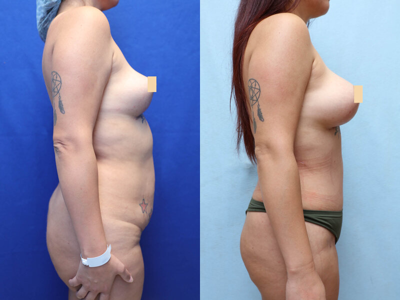 Mommy Makeover before and after, right side view