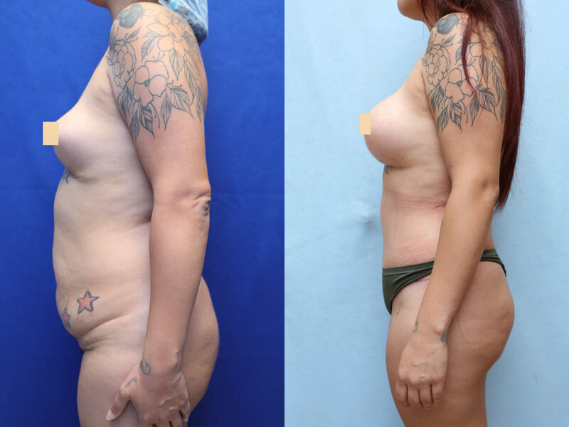 Mommy Makeover before and after, left side view
