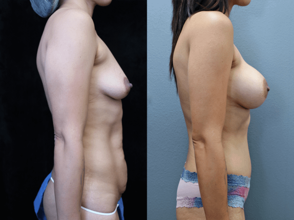 Mommy Makeover Before & After Photos Right Side