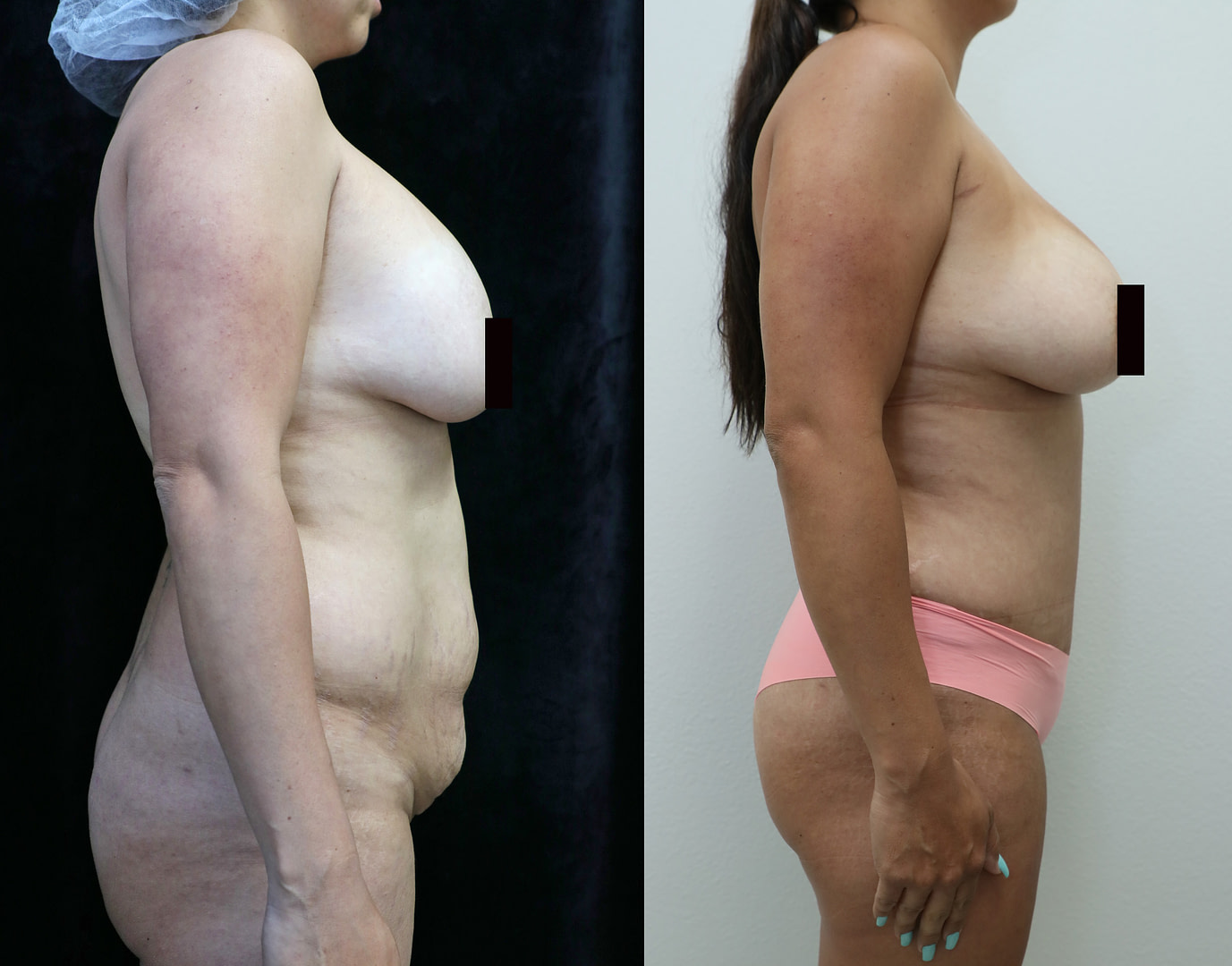 Mommy Makeover