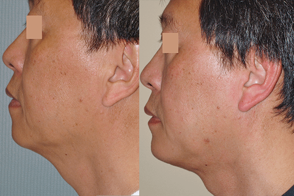 neck liposuction Before & After Photos Left