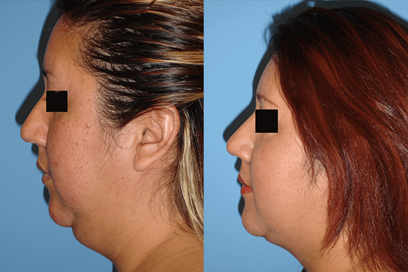 neck liposuction Before & After Photos Left