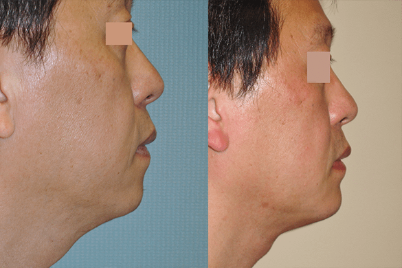 neck liposuction Before & After Photos Right