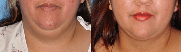 neck liposuction Before & After Photos