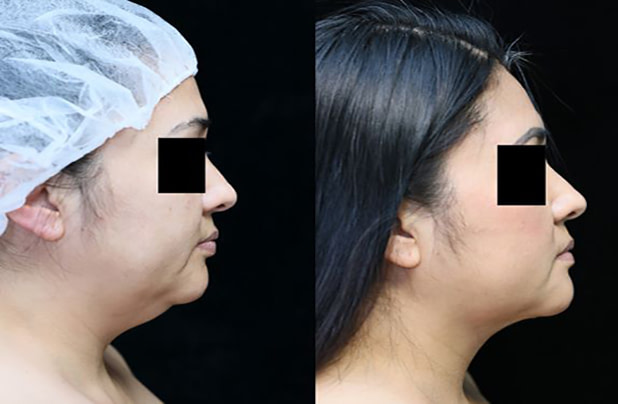 neck liposuction before and after photos right