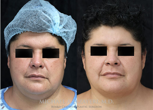 neck liposuction