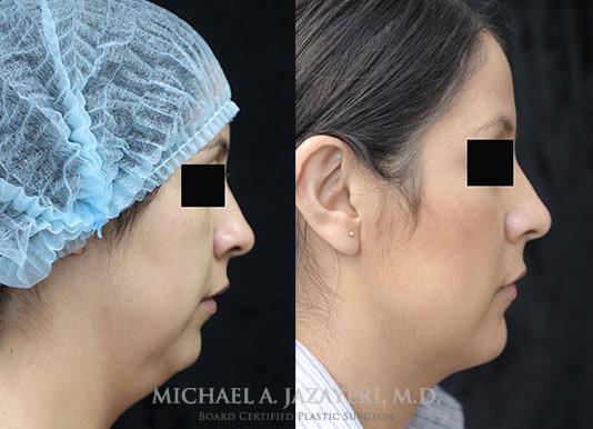 neck liposuction before and after right