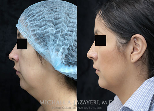 neck liposuction before and after right