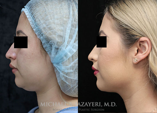 neck liposuction before and after left