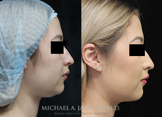 neck liposuction before and after right