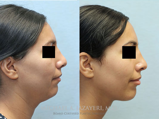 neck liposuction and fat transfer to chin
