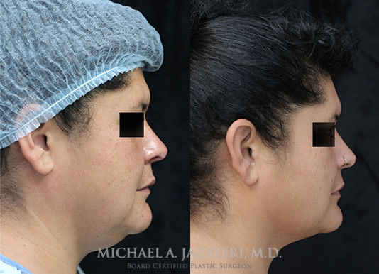 neck liposuction orange county