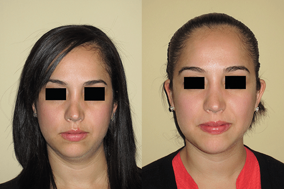 Non Surgical Nose Job Before & After Photos