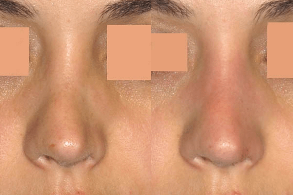 Non Surgical Nose Job Before & After Photos