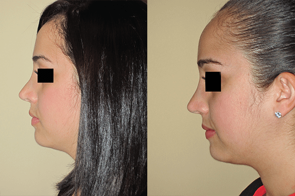 Non Surgical Nose Job Before & After Photos Left