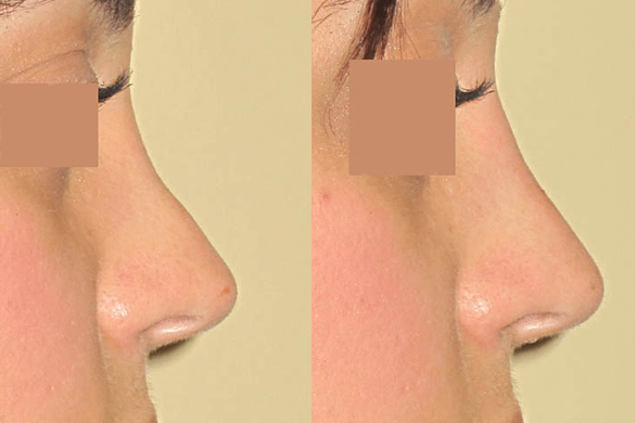 Non Surgical Nose Job Before & After Photos Right