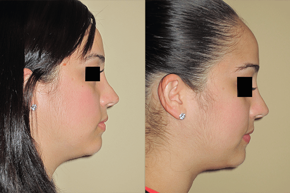 Non Surgical Nose Job Before & After Photos Right