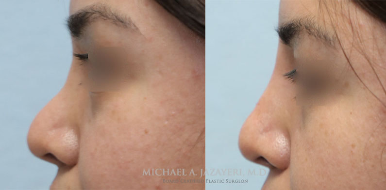 Non surgical nose job before and after