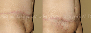 Pubic Lift Before & After Photos