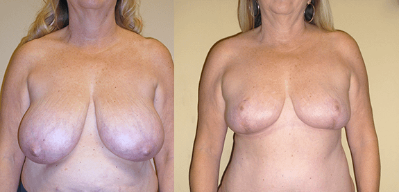 Breast Reduction Before & After Photos