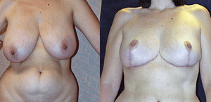 Breast Reduction Before & After Photos