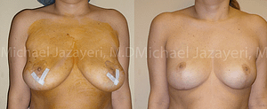 Breast Reduction Before & After Photos