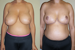 Breast Reduction Before & After Photos