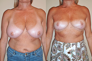 Breast Reduction Before & After Photos