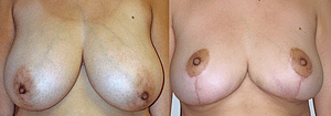 Breast Reduction Before & After Photos