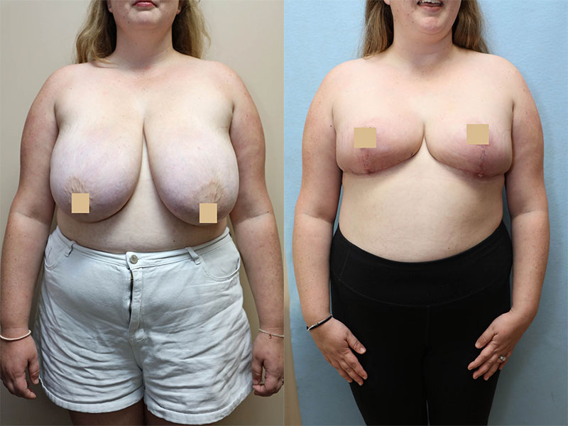breast reduction before and after front