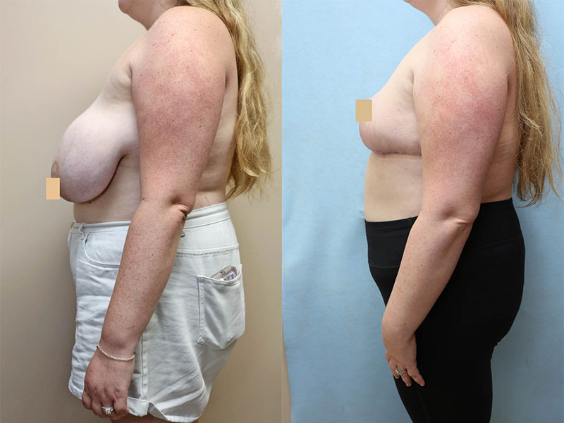breast reduction before and after left